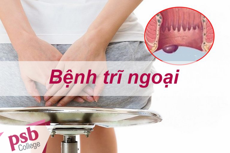 Bệnh trĩ ngoại