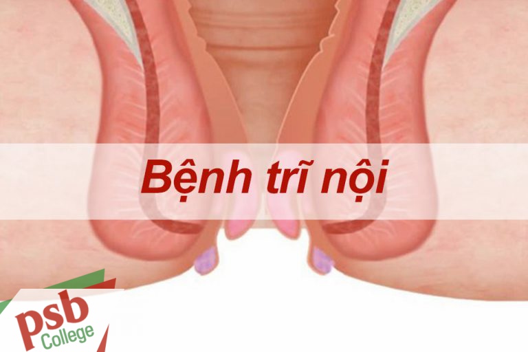 Bệnh trĩ nội