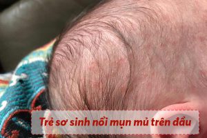 Trẻ sơ sinh bị nổi mụn mủ trên đầu