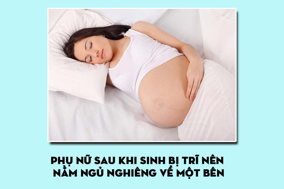 Phụ nữ sau khi sinh bị trĩ nên nằm ngủ nghiêng về một bên