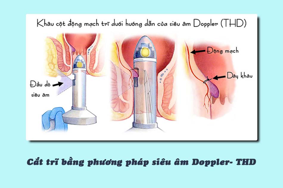 Cắt trĩ bằng phương pháp siêu âm Doppler- THD