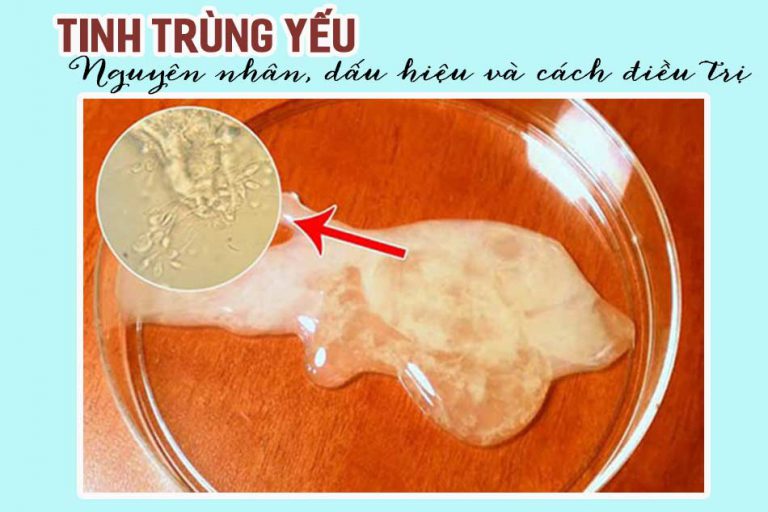 Tinh trùng yếu: Nguyên nhân, dấu hiệu và giải pháp