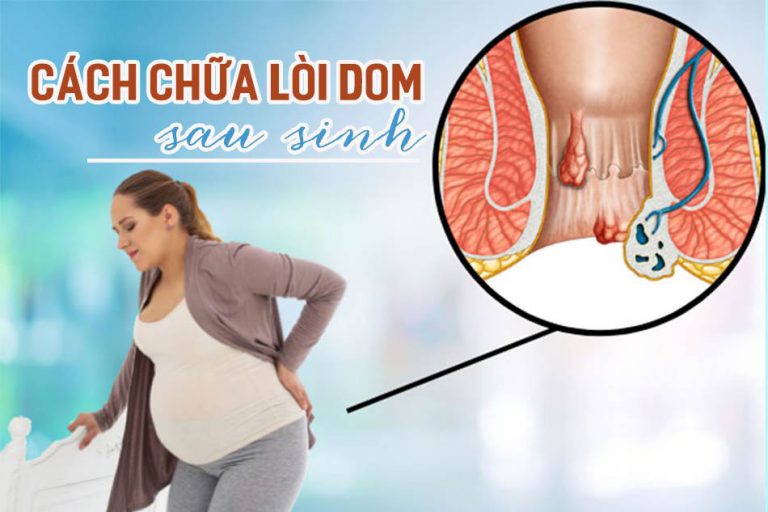 Cách chữa lòi dom sau sinh