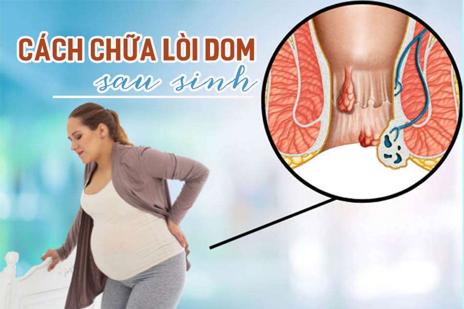 Cách chữa lòi dom sau sinh