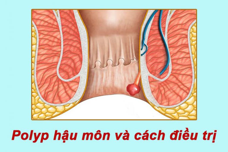 Polyp hậu môn