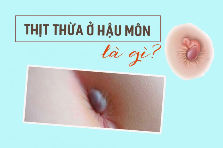 Thịt thừa ở hậu môn